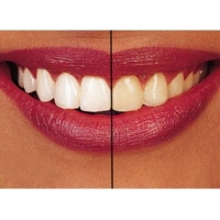 Opalescence — домашнее отбеливание зубов за короткое время.